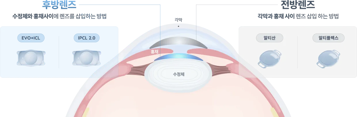 후방렌즈와 전방렌즈 비교 : 후방렌즈는 수정체와 홍채 사이에 렌즈를 삽입하는 방법이고 전방렌즈는 각막과 홍채 사이에 렌즈를 삽입하는 방법