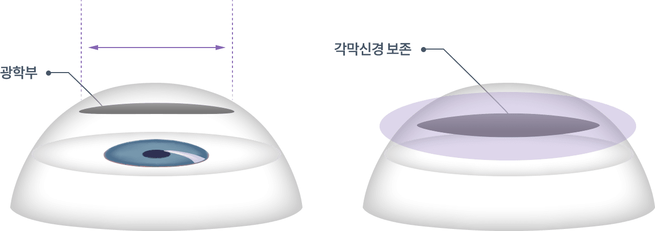 실크스마일라식 장점 이미지