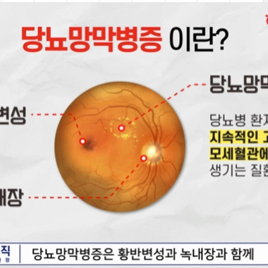 강남서울밝은안과